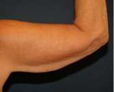 Arm Reduction 215 - before