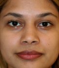 Rhinoplasty Nostril Narrowing - before