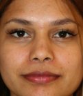 Rhinoplasty Nostril Narrowing - after