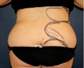 Liposuction Back-Flanks 213 - before