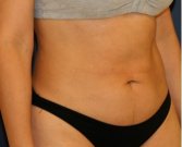 Liposuction Flanks 215 - before