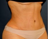 Liposuction Flanks 215 - after