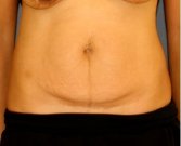 Tummy Tuck 245 - before