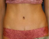 Tummy Tuck 245 - after