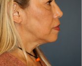 Necklift 206 - before