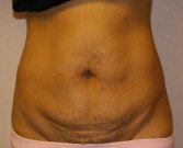 Tummy Tuck Case 16 - before