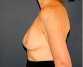 Deflated Left Implant Replacement 412 - before