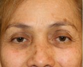 Blepharoplasty 110 - before