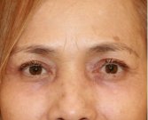 Blepharoplasty 110 - after