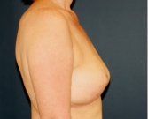 Breast Implant Removal 203 - after