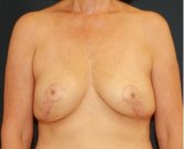 Breast Lift 310 - after