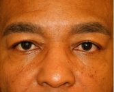 Blepharoplasty 111 - before