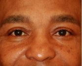 Blepharoplasty 111 - after