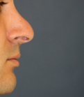 Rhinoplasty 215 - before