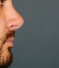 Rhinoplasty 215 - after