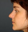Rhinoplasty 216 - before