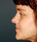 Rhinoplasty 216 - after