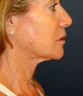 Necklift 207 - before