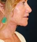 Necklift 207 - after