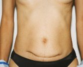 Revision Abdominoplasty - before