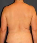Waist to Butt 1 - before