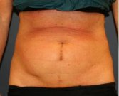 Tummy Tuck 249 - before