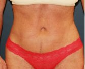 Tummy Tuck 249 - after