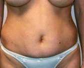 Tummy Tuck Case 10 - before