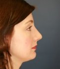 Rhinoplasty Case 18 - after