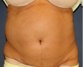 Tummy Tuck 250 - before