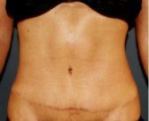 Tummy Tuck 250 - after