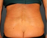 Liposuction 218 Back-Waist-Flanks - before