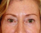 Blepharoplasty 112 - after