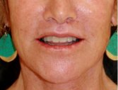 Lip Lift and Corner Lip Lift 213 - after