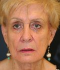 Facelift 106 - before
