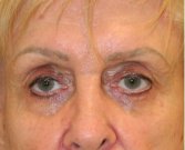 Blepharoplasty 113 - before