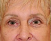 Blepharoplasty 113 - after