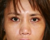 Blepharoplasty Case 27 - after