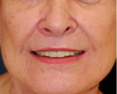 Lip Lift and Corner Lip Lift 214 - after