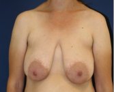 Breast Lift 311 - before
