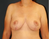 Breast Lift 311 - after