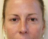 Blepharoplasty Case 28 - before