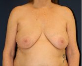 Breast Lift 312 - before