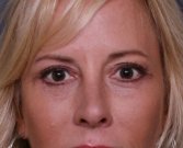 Blepharoplasty Case 28 - after