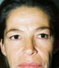 Browlift Case 1 - before