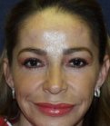 Browlift Case 1 - after