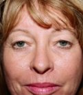 Browlift Case 3 - before