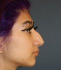 Rhinoplasty 218 - before