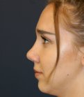 Rhinoplasty 219 - after