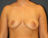 Breast Asymmetry 106 - before